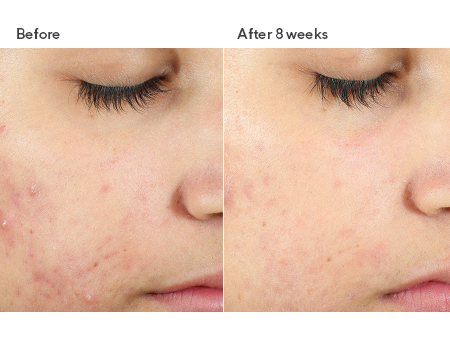 TRATTAMENTO INVISISCAR™ RESURFACING