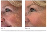 THE SKINCARE TOOLS 4D Pro Laser Light Therapy Face Mask