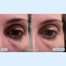 NuFace IONPLEX® HYDRA-GEL POWER PATCHES
