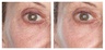 U Beauty Resurfacing Flash Peel